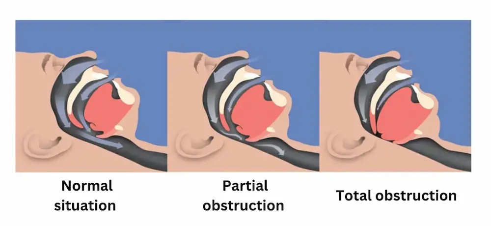 Figure 3. Illustration of obstructive sleep apnea