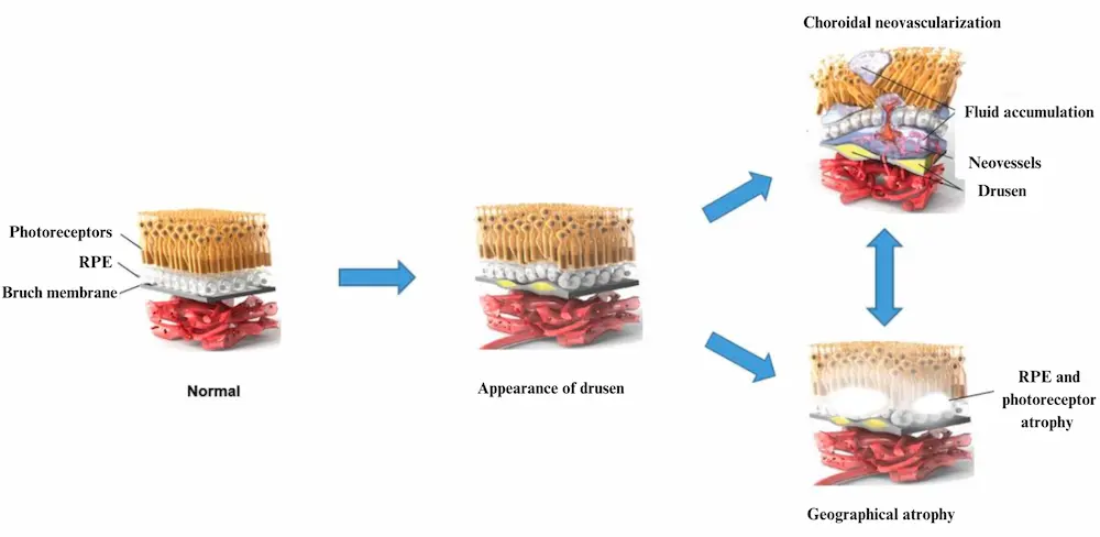 Figure 3 Visualizing the progression of age-related macular degeneration